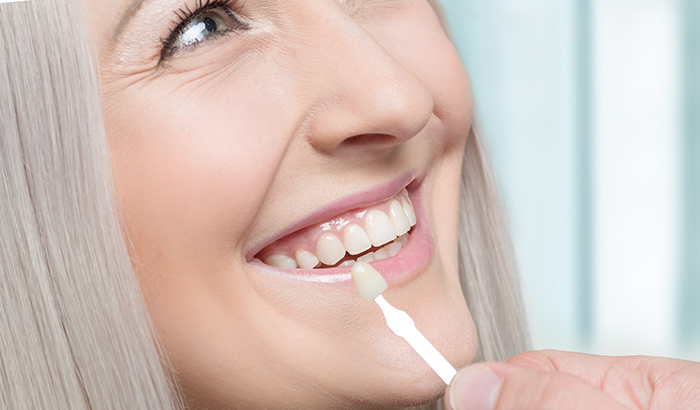 How-Long-Do-Dental-Veneers-Last-on-Average Woman smiling at dentist during veneer procedure at Cascadia Family Dental in Bend, OR